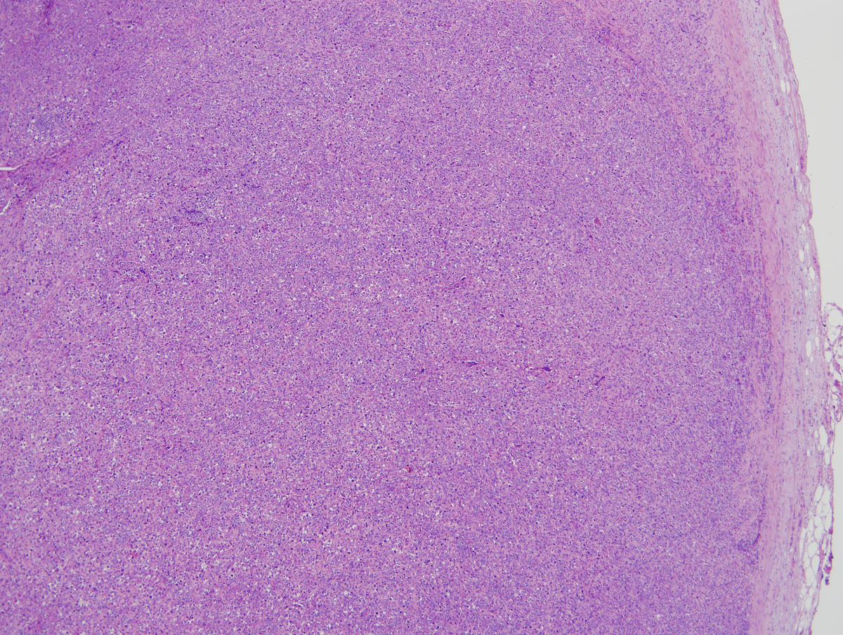 Lymph node with complete effacement of nodal architecture by varibly sized blasts